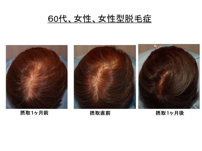 女性　脱毛症　病院""